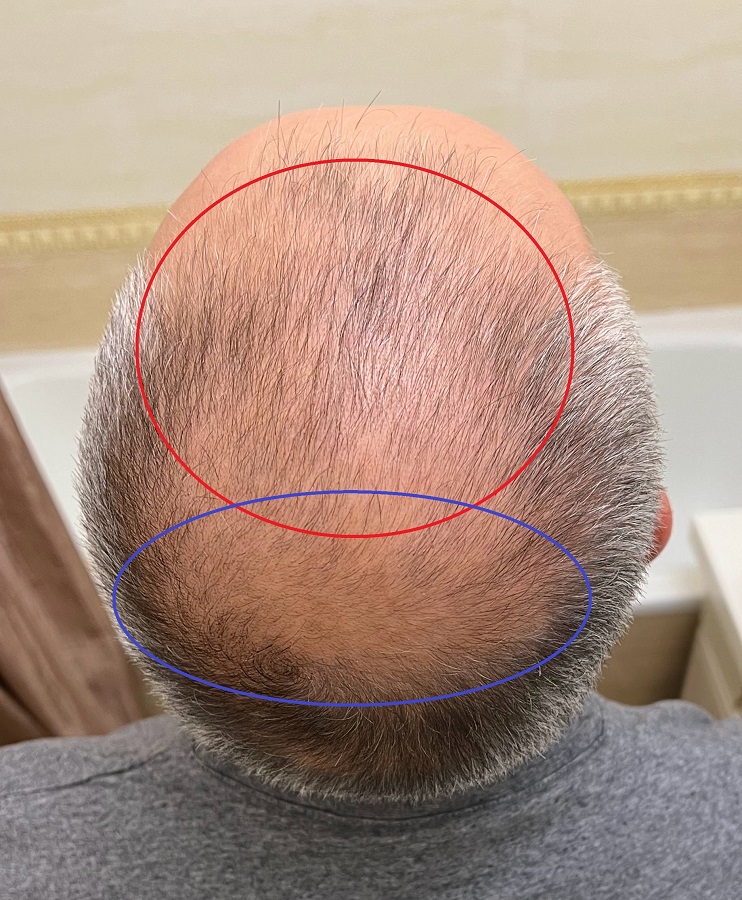 Операция по пересадке волос - объем