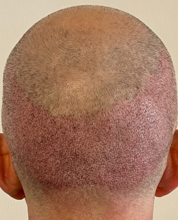 Донорская зона на 2й день после пересадки волос
